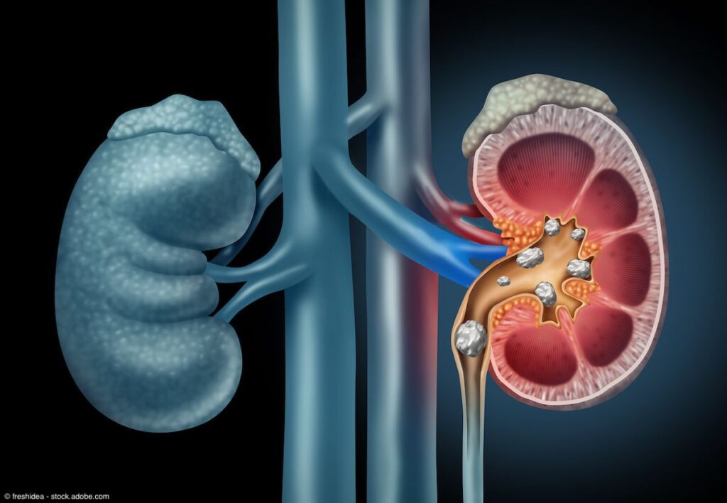 Alterations in the microbiome linked to kidney stone formation