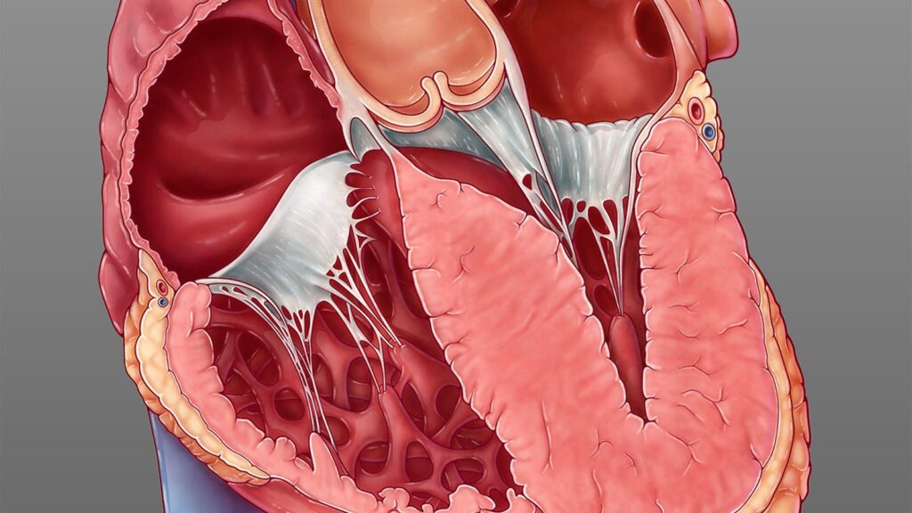 A medical illustration of hypertrophic cardiomyopathy